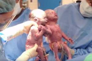 FOTO & VIDEO / S-au născut ţinându-se de mână, iar medicii le-au dat 50% şanse de supravieţuire! Au trecut doi ani şi acum arată aşa