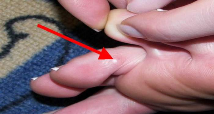 Articulatiile degetelor pot trada artroza genunchiului [studiu]