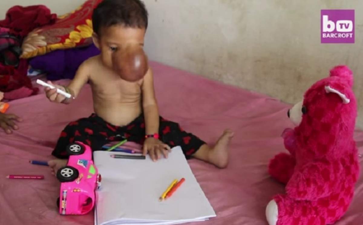 VIDEO / Povestea cutremurătoare a unei fetiţe de 11 luni! Micuţa are faţa acoperită de o tumoră imensă