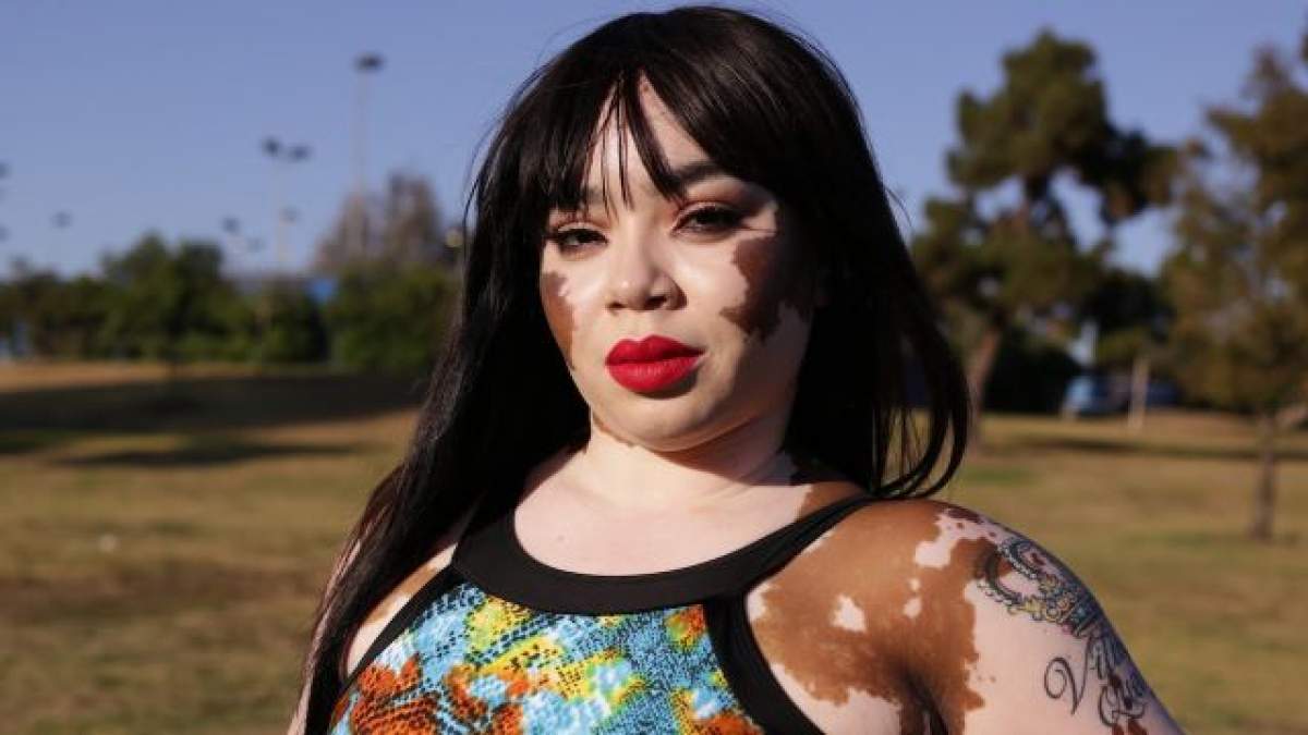 VIDEO / Este numită ”regina vitiligo”, iar povestea ei este emoționantă! Cum arăta înainte de boala care i-a schimbat complet viața