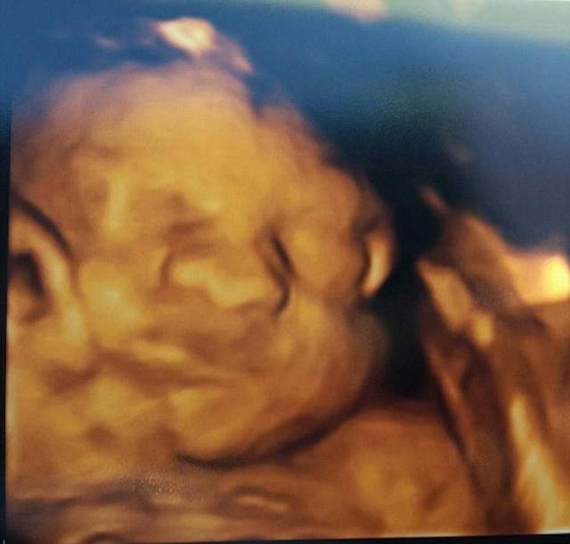 FOTO / I s-a spus că fiul ei se va naşte cu organele în exteriorul corpului, dar a refuzat avortul! Cum arată copilul căruia medicii nu i-au dat nicio şansă