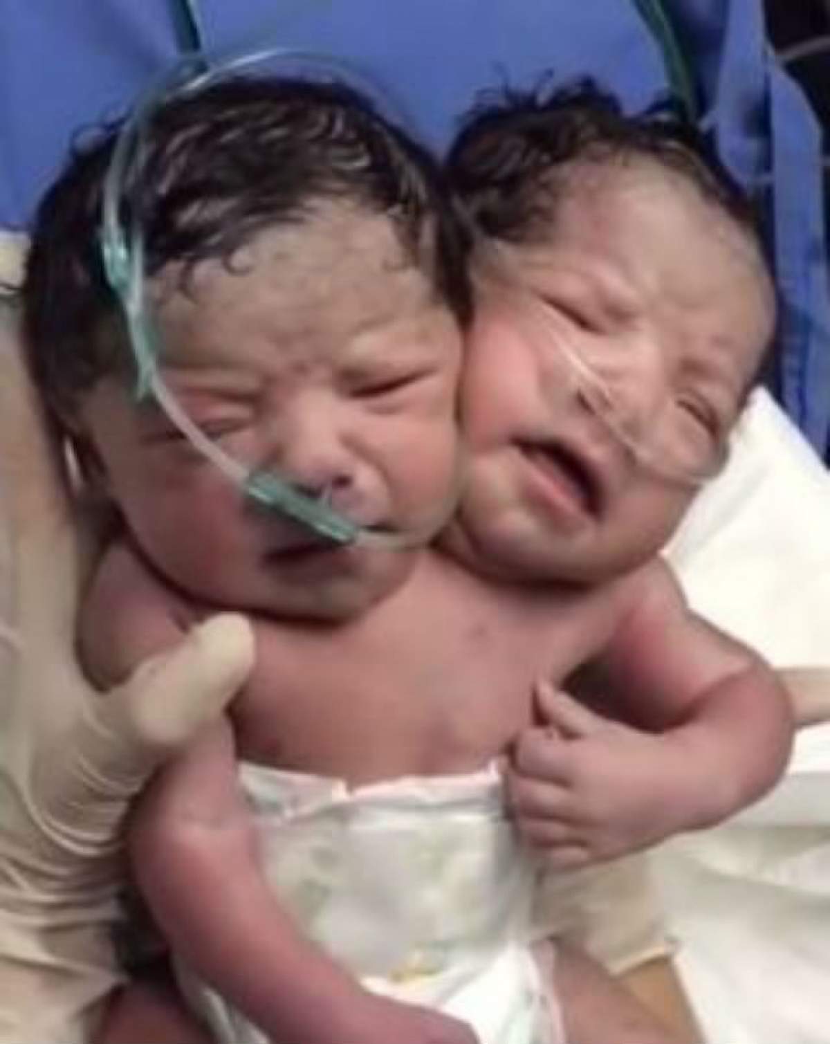 VIDEO / Un bebeluş s-a născut cu două capete! Imaginile sunt terifiante