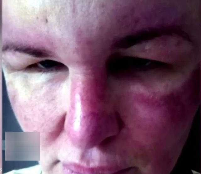 VIDEO & FOTO / Faţa unei femei "s-a topit" şi a rămas oarbă, după ce a apelat la o procedură de înfrumuseţare folosită de milioane de femei