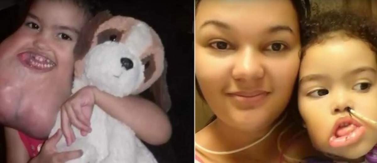 VIDEO / Avea o tumoare imensă pe faţă! După o operaţie complicată, fetiţa arată total diferit