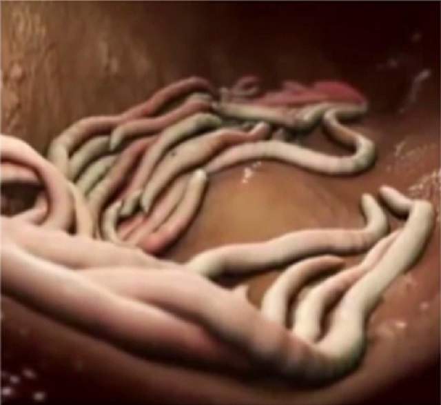 VIDEO / Întrebarea zilei: Luni - Ce sunt paraziţii intestinali şi cum pot fi eliminaţi?