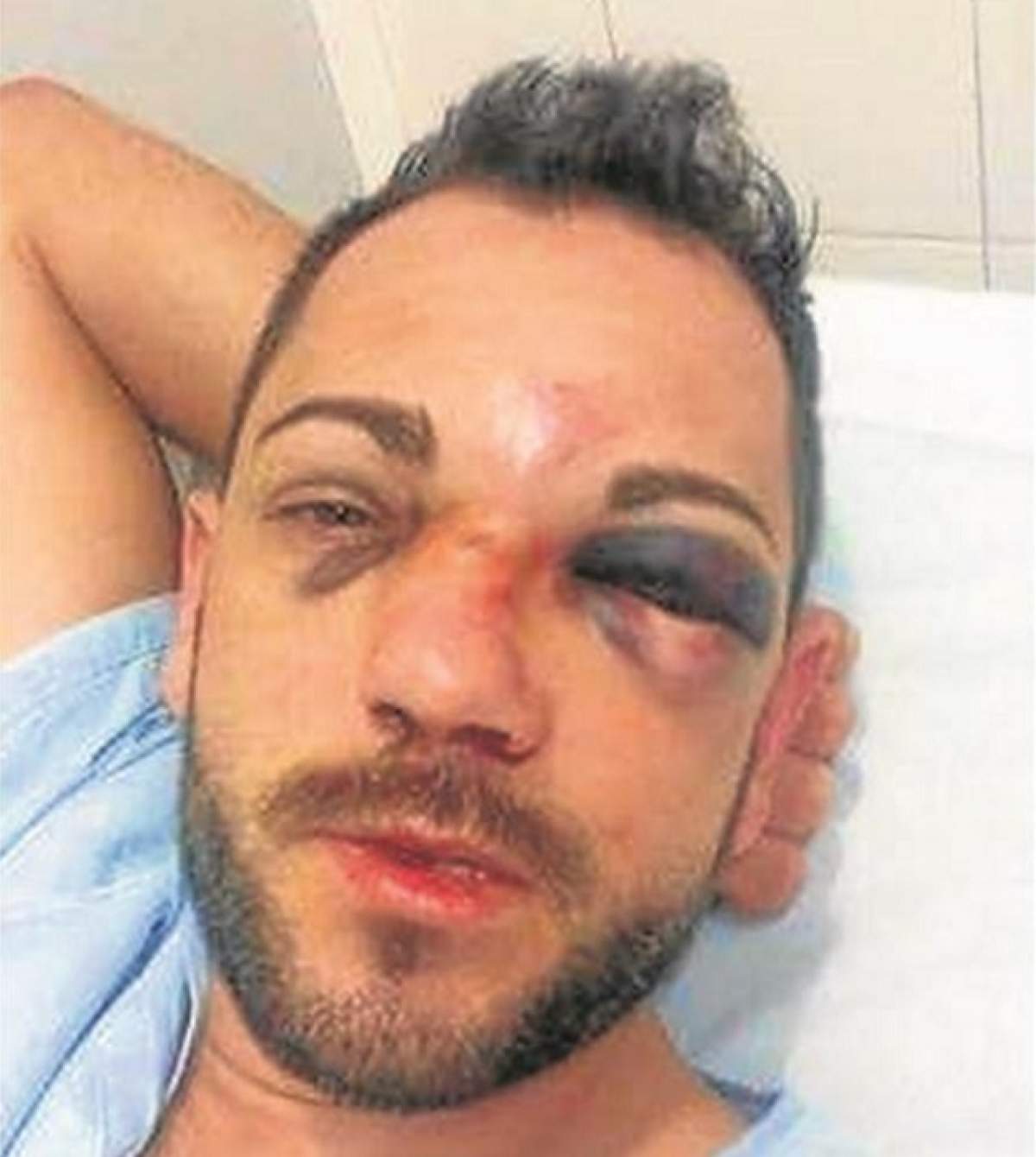 Român bătut cu sălbăticie în Spania de alţi români! E desfigurat, are răni multiple şi o fractură nazală