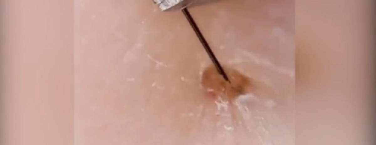 VIDEO / Tu ai văzut vreodată cum se scoate un fir de păr de sub piele? Iată de ce trebuie să faci asta