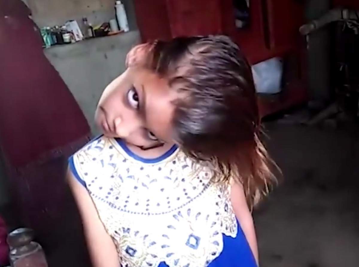 FOTO / Înfiorător! O fetiță de 9 ani duce viață chinuită după ce s-a născut cu gâtul strâmb. Durerea este mare