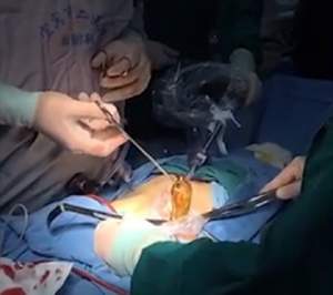 VIDEO / TERIBIL! A mers la spital din cauza durerilor, iar ce au găsit medicii în corpul unui bărbat i-a şocat