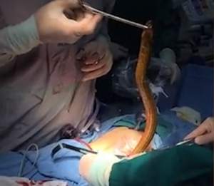VIDEO / TERIBIL! A mers la spital din cauza durerilor, iar ce au găsit medicii în corpul unui bărbat i-a şocat
