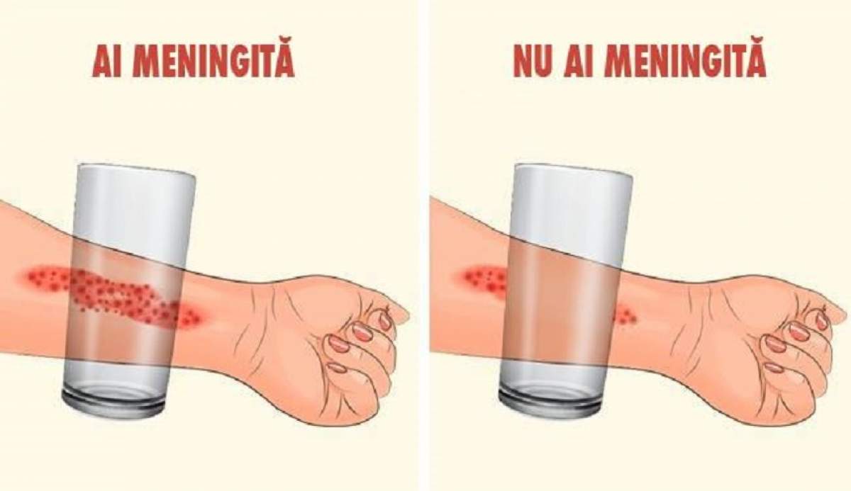 Cele 7 simptome ale meningitei la care părinții ar trebui să fie atenți