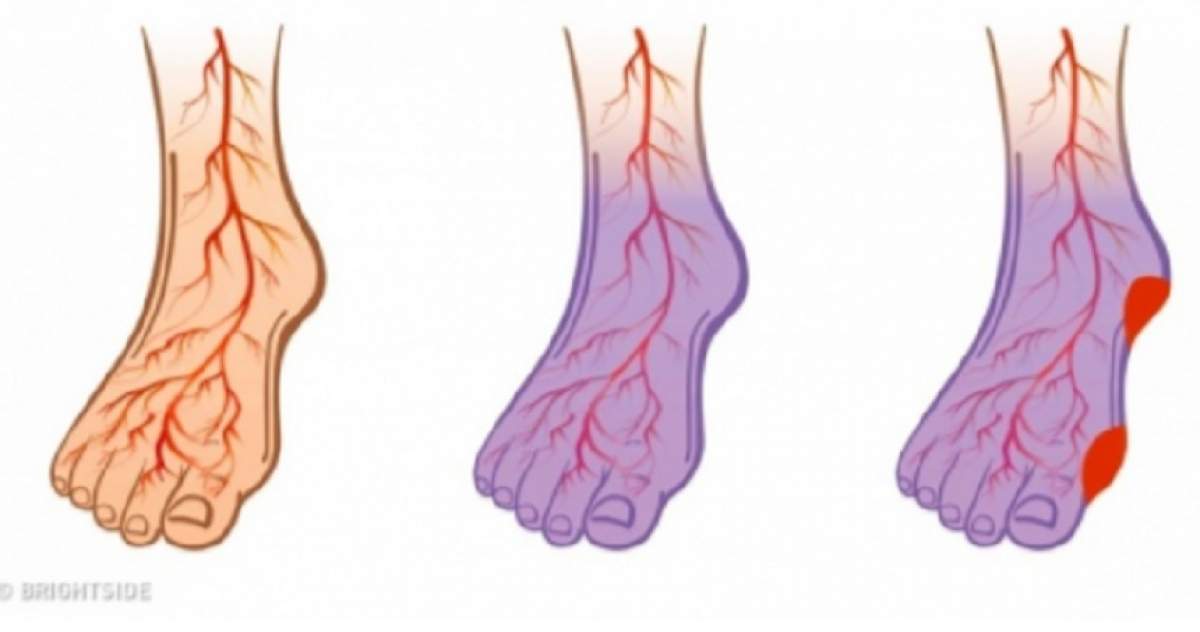 Ai picioarele reci, te dor și au apărut varicele? 7 lucruri pe care trebuie să le faci imediat!