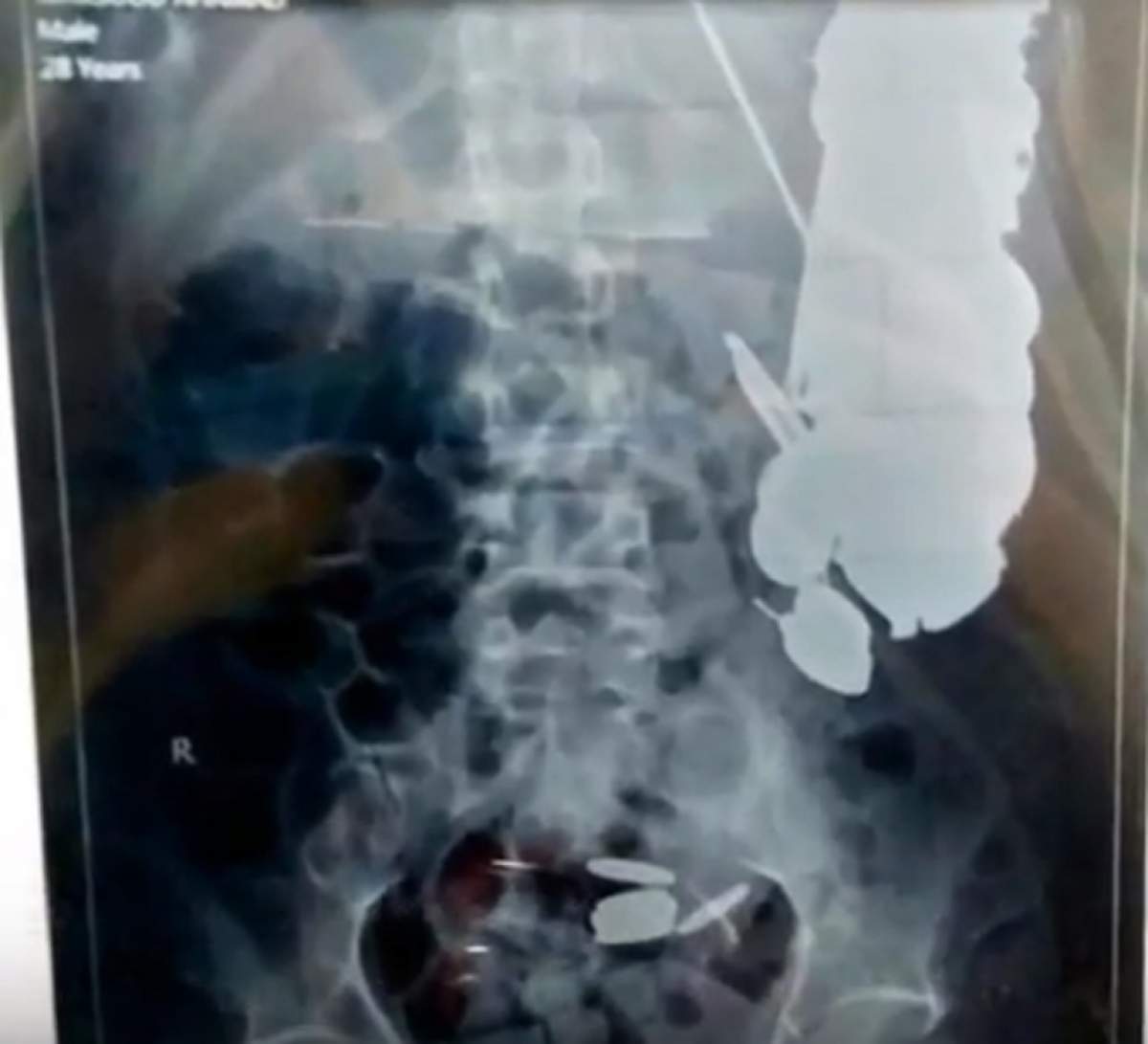 Un bărbat a ajuns pe masa de operaţie, dar medicii au fost şocaţi de ce au găsit în stomacul său