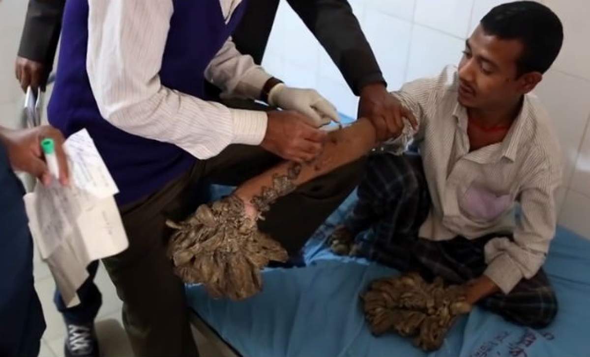 VIDEO / O copilă de 10 ani se transformă în copac! La propriu! Rudele ei se roagă pentru o minune