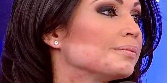 FOTO / Acneea le dă mari bătăi de cap! Ele sunt vedetele care se luptă cu imperfecțiunile tenului
