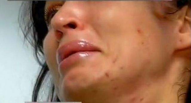 FOTO / Acneea le dă mari bătăi de cap! Ele sunt vedetele care se luptă cu imperfecțiunile tenului