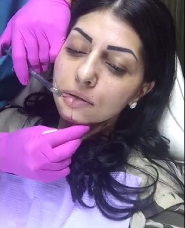 VIDEO / O vedetă de la noi s-a filmat în timp ce îşi injectează buzele! Cum arată la sfârşitul intervenţiei