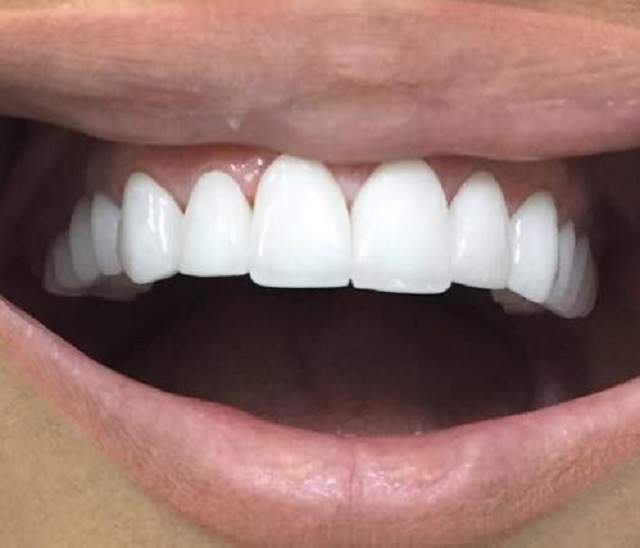 FOTO / Oana Zăvoranu şi-a pus faţete dentare! Cum arată acum bruneta intrată în rândul divelor cu "termopane"