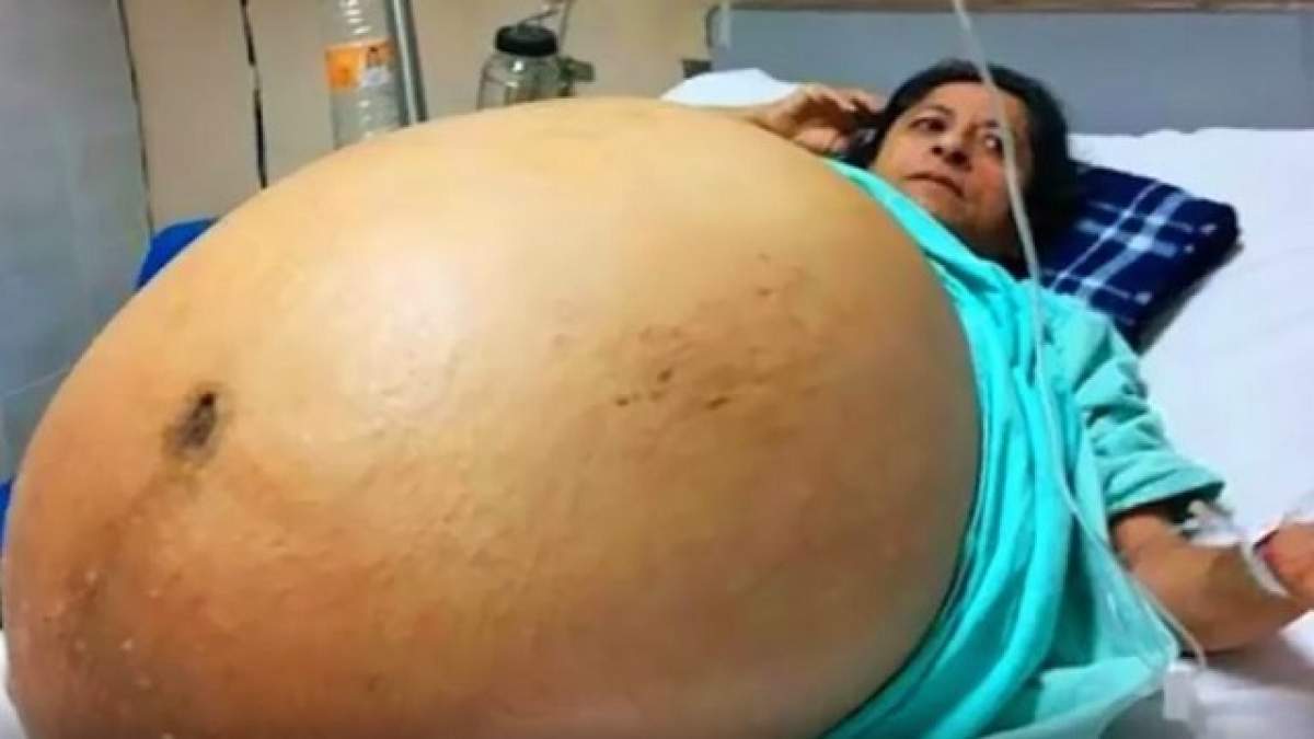 VIDEO / A fost salvată în ultima secundă! O femeie avea o tumoră de 32 de kilograme