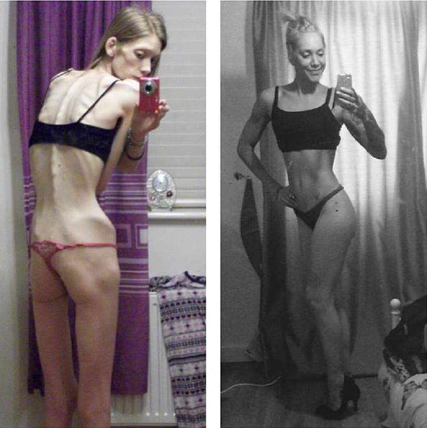 FOTO / Transformarea spectaculoasă a unei tinere anorexice! Cântărea 25 de kilograme, dar acum e campioană la fitness