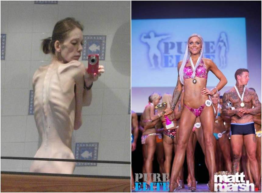 FOTO / Transformarea spectaculoasă a unei tinere anorexice! Cântărea 25 de kilograme, dar acum e campioană la fitness