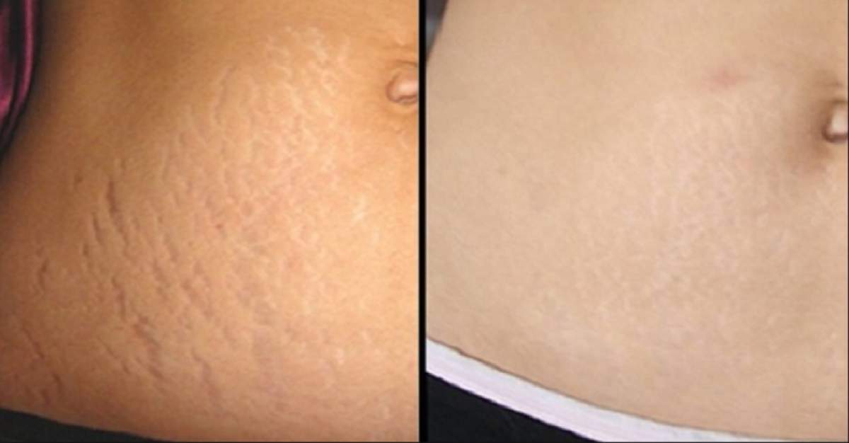 VIDEO / Care este cauza apariţiei vergeturilor şi cum pot fi prevenite!