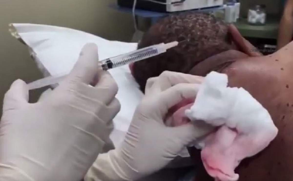 VIDEO / O tumoră uriașă i-a fost îndepărtată de pe ceafă! Medicii s-au îngrozit. Imagini greu de privit