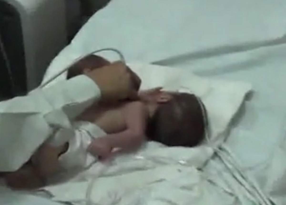 VIDEO / Caz şocant! Un bebeluş s-a născut cu încă un cap, prins de stomac