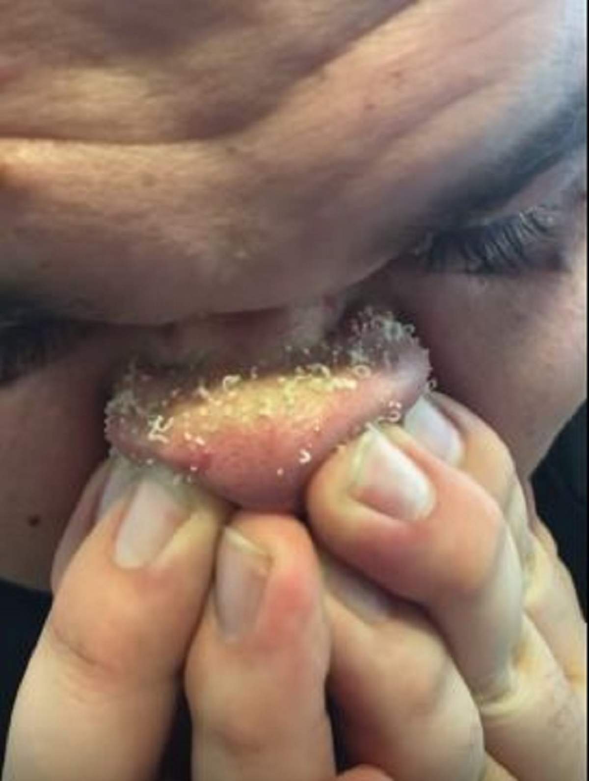 VIDEO / Un bărbat a descoperit cum să-și scoată punctele negre de pe nas! Imaginile îți vor întoarce stomacul pe dos