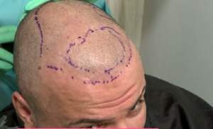 Dan Helciug şi-a făcut implant de păr: "Copiii mei vor avea un şoc"