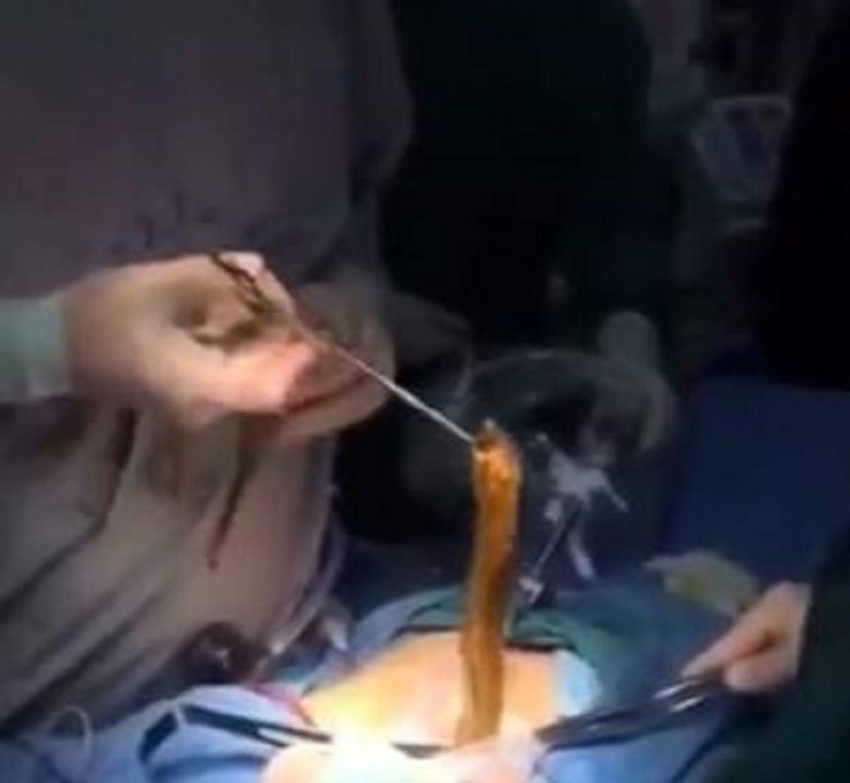 VIDEO / Doctorii l-au operat și i-au scos o anghilă din stomac! Imaginile sunt greu de privit