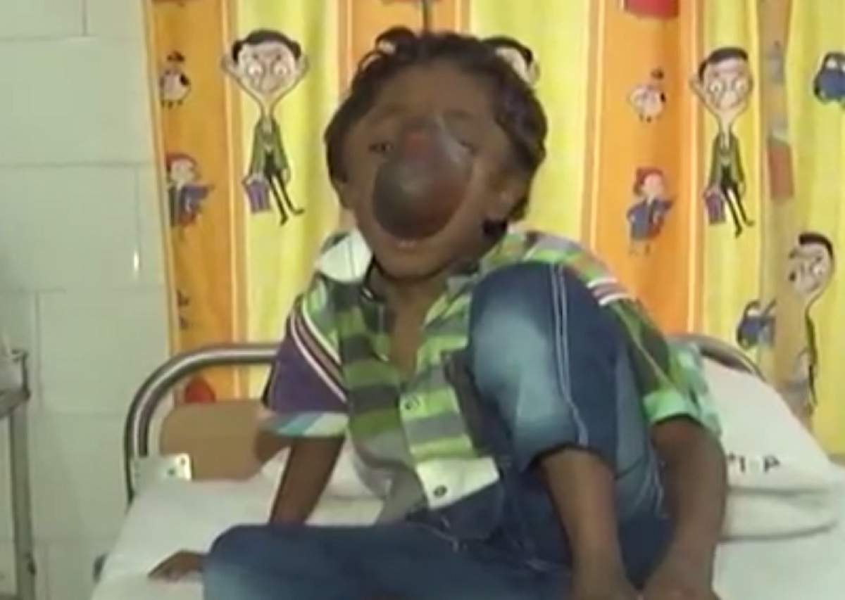 FOTO /Un copil de 9 ani, orfan, se luptă cu o malformaţie uriaşă pe faţă! Imagini greu de privit