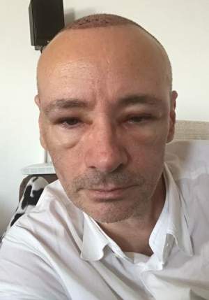 FOTO / După implantul de păr, Mihai Albu e... tot chel! Cum a apărut la aproape 8 luni de la procedură