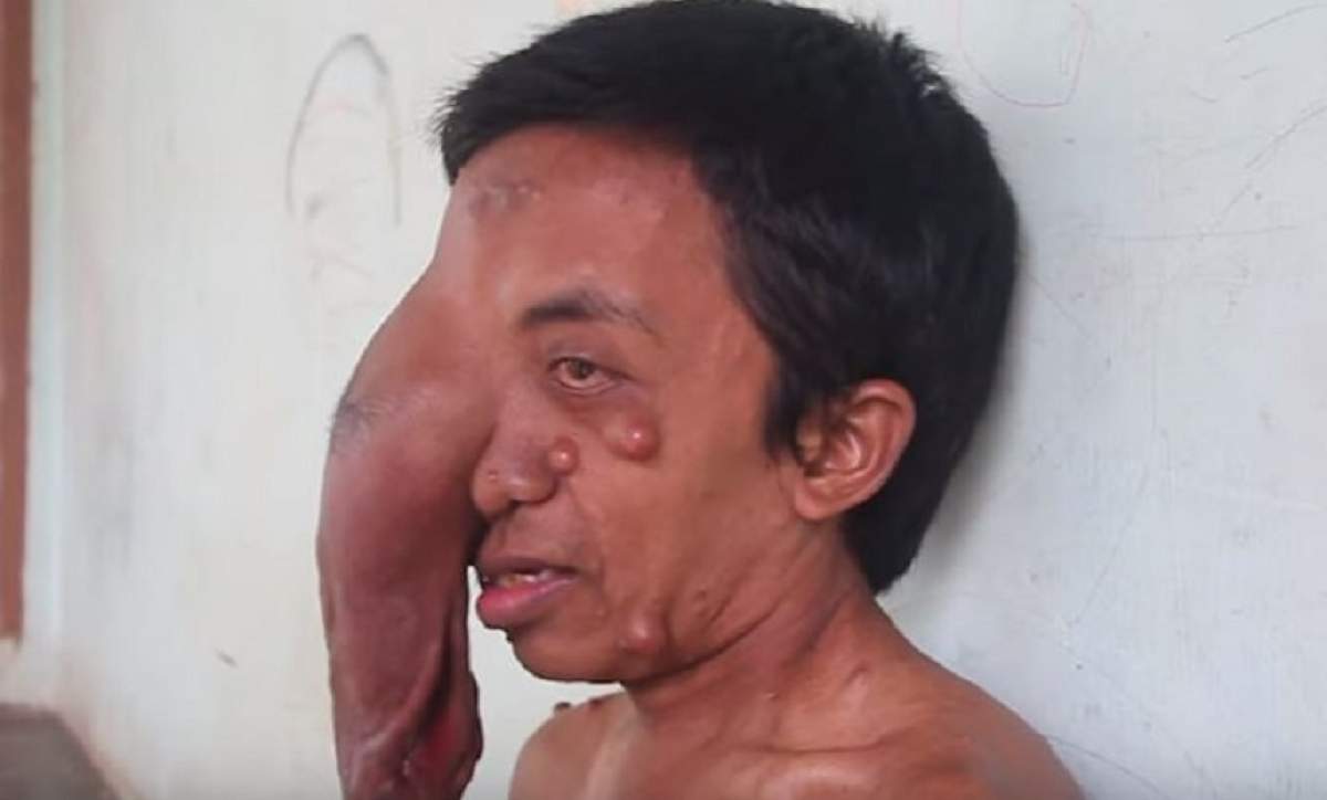 VIDEO / Un bărbat cu o tumoră imensă pe față strigă disperat după ajutor!