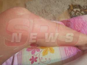 FOTO / O tânără și-a distrus picioarele după ce s-a epilat la un salon din București:"Efectiv sunt jupuită de piele!"