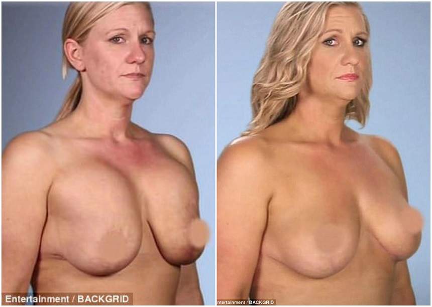A vrut să îşi micşoreze sânii, dar s-a ales cu implanturi nedorite! Cum arată femeia care a ajuns să îşi urasca trupul