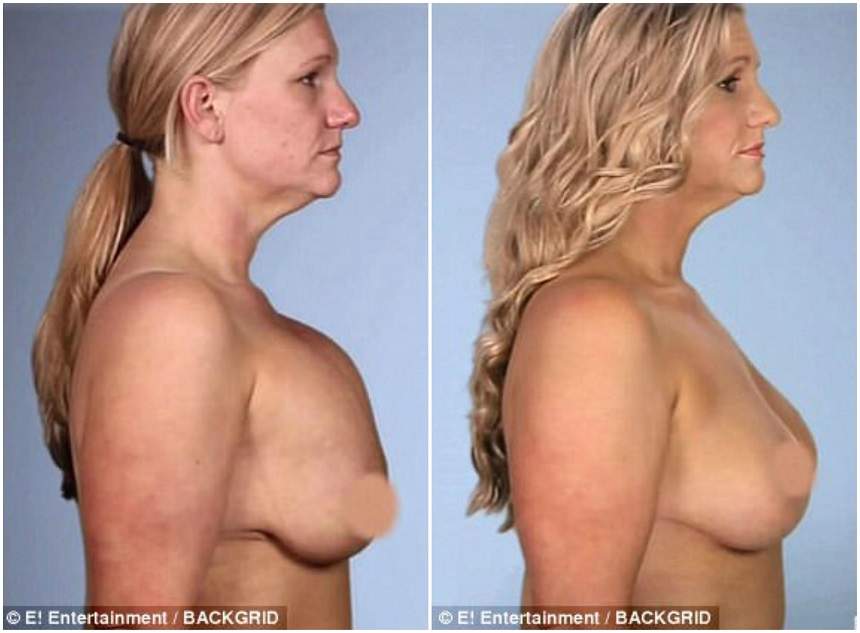 A vrut să îşi micşoreze sânii, dar s-a ales cu implanturi nedorite! Cum arată femeia care a ajuns să îşi urasca trupul