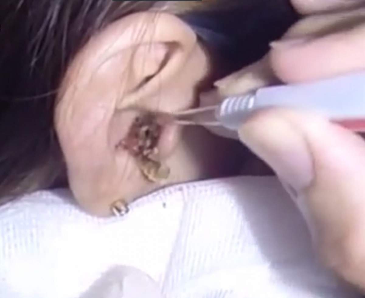 VIDEO / Imagini greu de privit! Doctorii s-au îngrozit când au văzut ce au scos din urechea unei femei