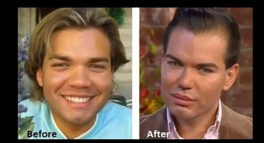 VIDEO / Veste ŞOC! Rodrigo Alves, supranumit păpuşă umană Ken, ar putea rămâne fără nas