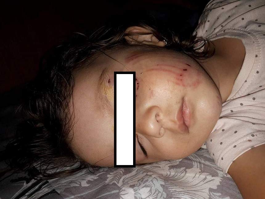 FOTO / O fetiță de 2 ani a fost mușcată de un câine în parc. E cutremurător cum s-a întâmplat