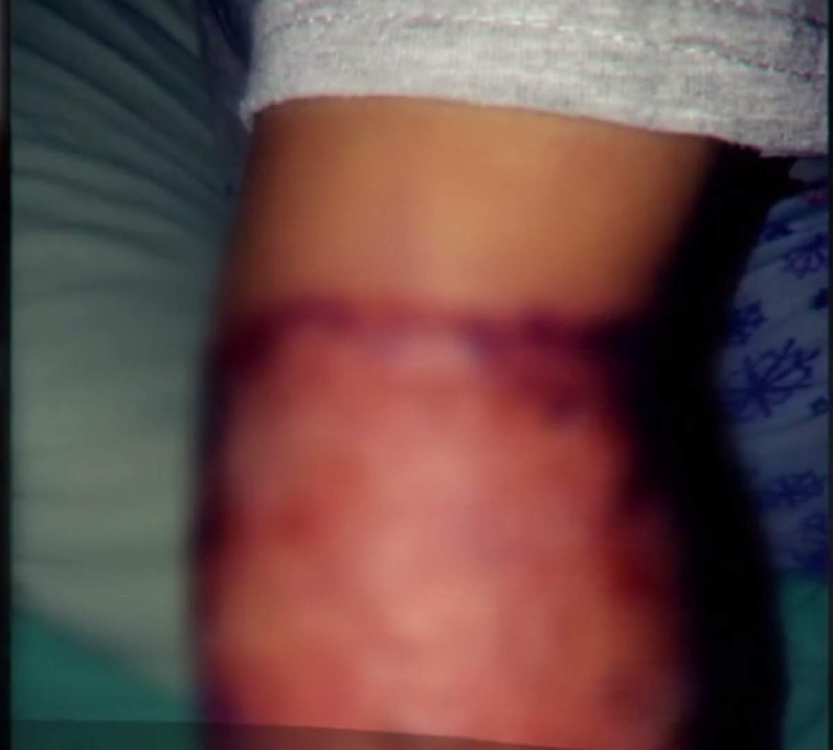 VIDEO / Copii mutilaţi într-un spital din Slatina! Părinţii au avut un şoc atunci când au dat jos leucoplastul