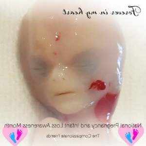 FOTO / O mamă distrusă de durere a publicat imaginea cu fătul ei mort în pântece, în a 14-a săptămână de sarcină