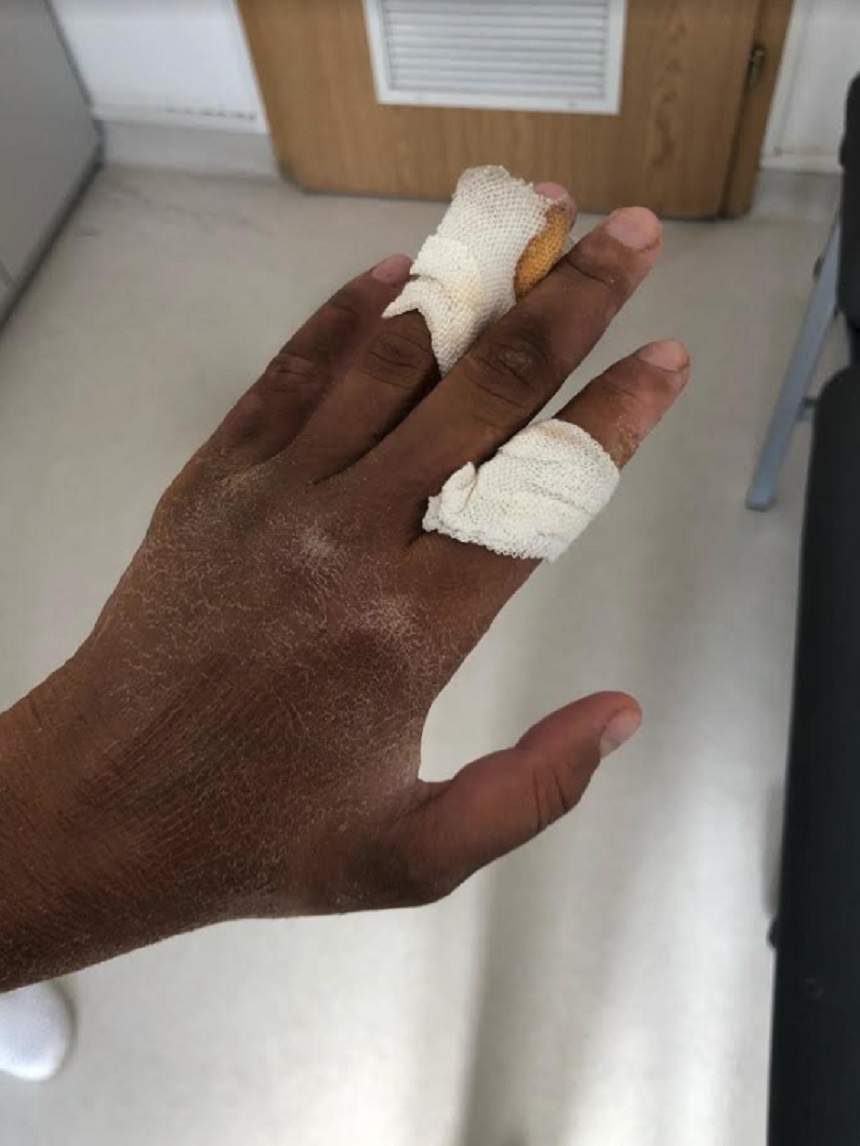 FOTO / Imagini şocante cu mâna ruptă a Danielei Crudu, după ce şi-a dat bandajele jos