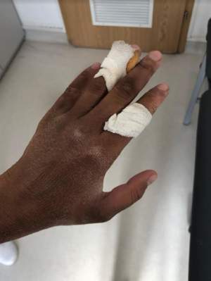 FOTO / Imagini şocante cu mâna ruptă a Danielei Crudu, după ce şi-a dat bandajele jos