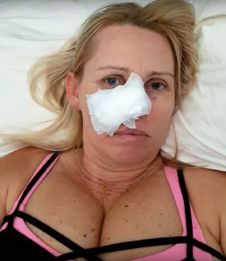 FOTO / A crezut că avea un semn de la ochelari, dar, de fapt avea cancer. Femeia este acum desfigurată. Atenție! Se poate întâmpla oricui!
