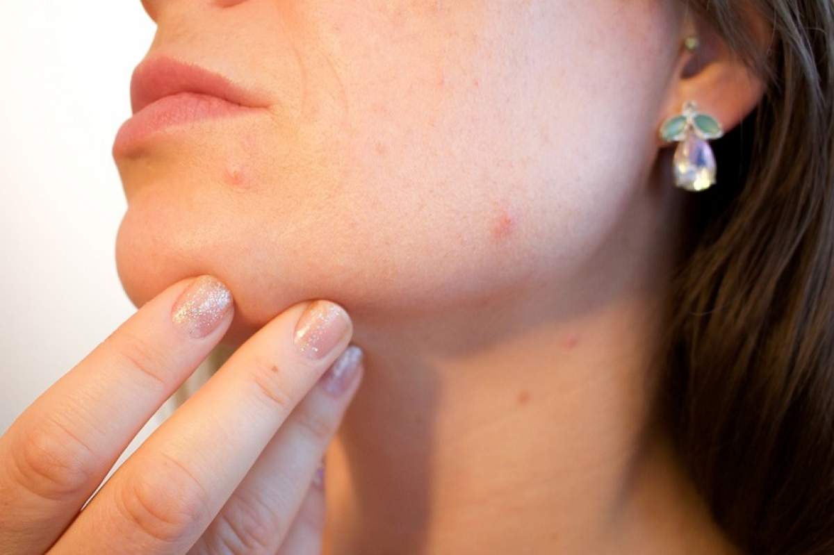 O bloggeriță și-a tratat de acneea cu ajutorul lichidului seminal. "Veți avea un ten strălucitor"