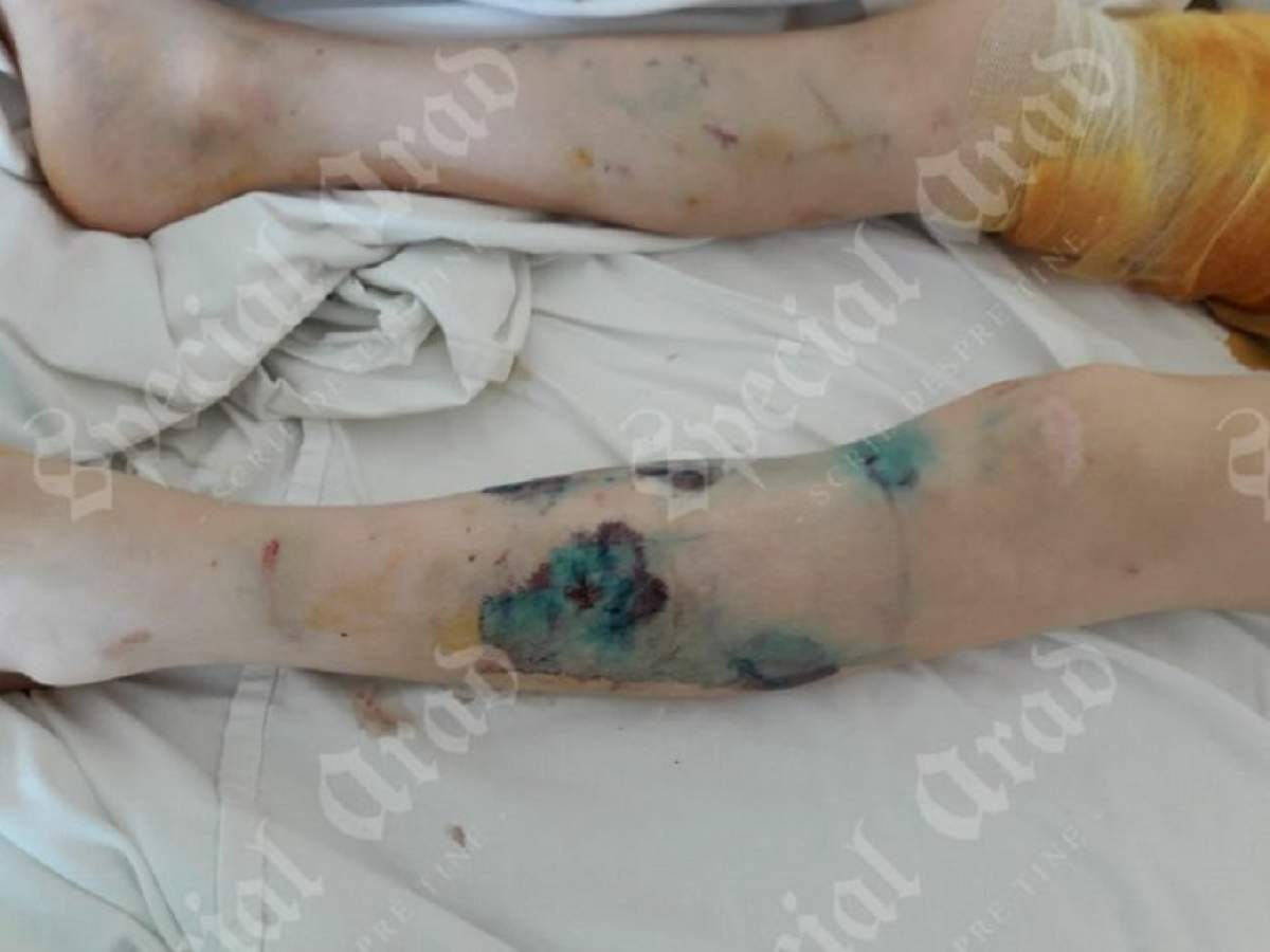 FOTO / Un copil de 9 ani a ajuns de urgență la spital, desfigurat de un ciobănesc german