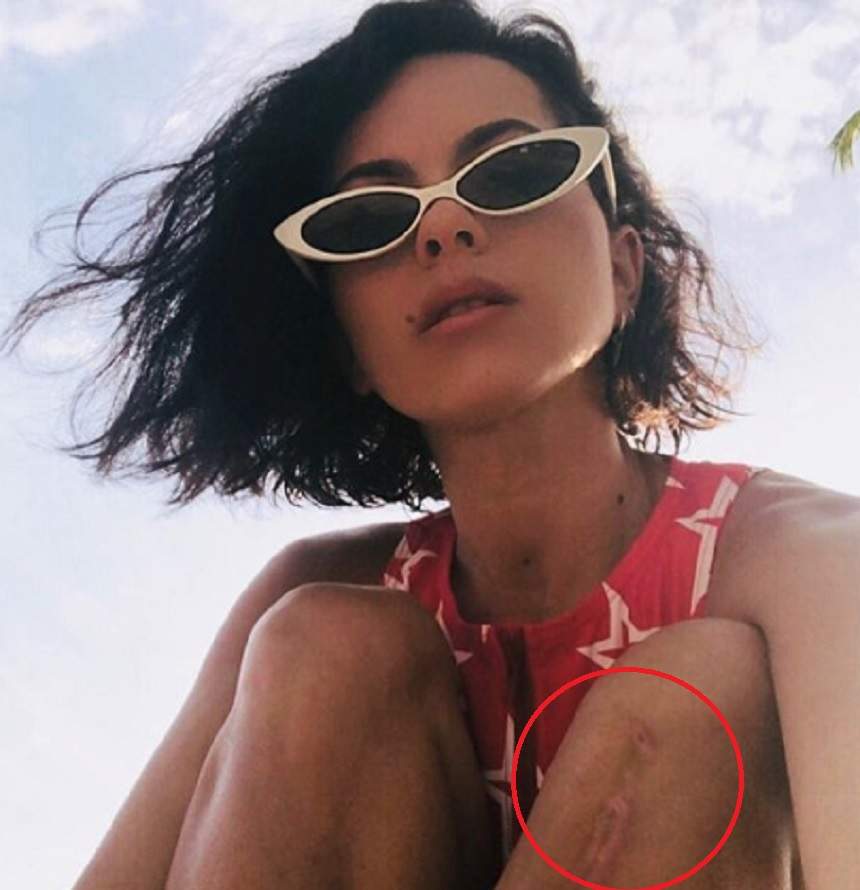 FOTO / Inna și-a arătat cicatricea imensă de pe picior, după ce a căzut de pe scenă în Istanbul