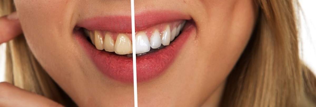 Întrebarea zilei: Cea mai simplă şi ieftină metodă pentru albirea dinților?