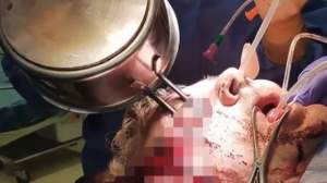 FOTO & VIDEO / Un bărbat a ajuns la spital cu mânerul unei tigăi în ochi, după o noapte de beție